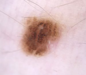 Melanocytic Nevus