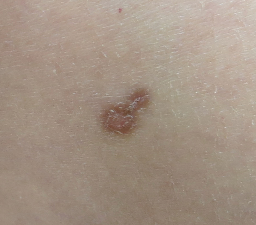dermatofibroma1 skin