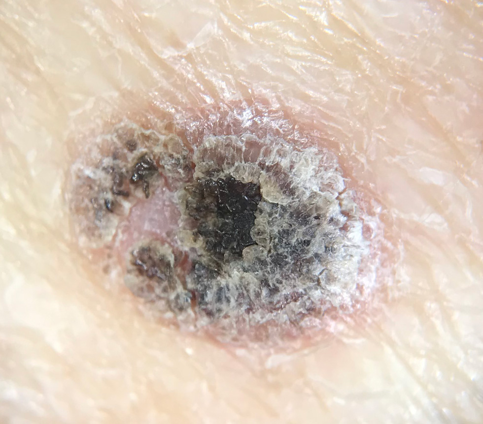 seborreickeratosis1 skin