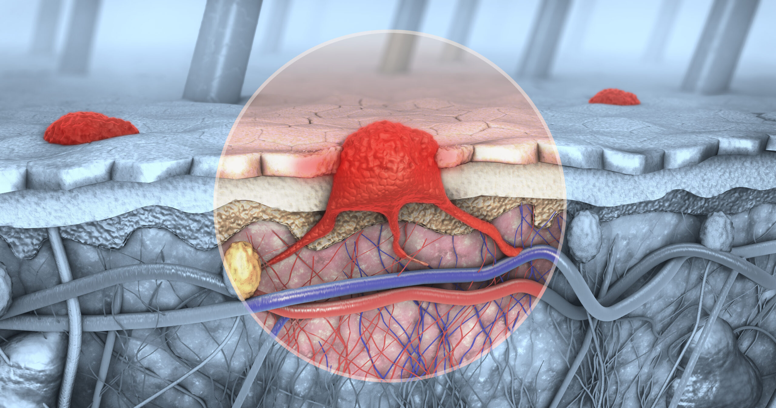 3d illustration of a cross-section of a diseased skin with melanoma that enters the bloodstream and lymphatic tract bump