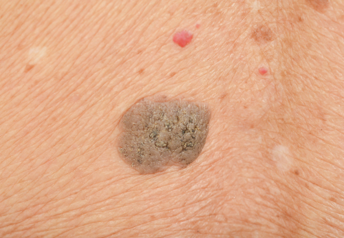 shutterstock_1005830362 skin