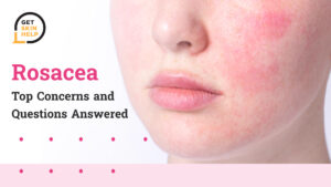 Rosacea