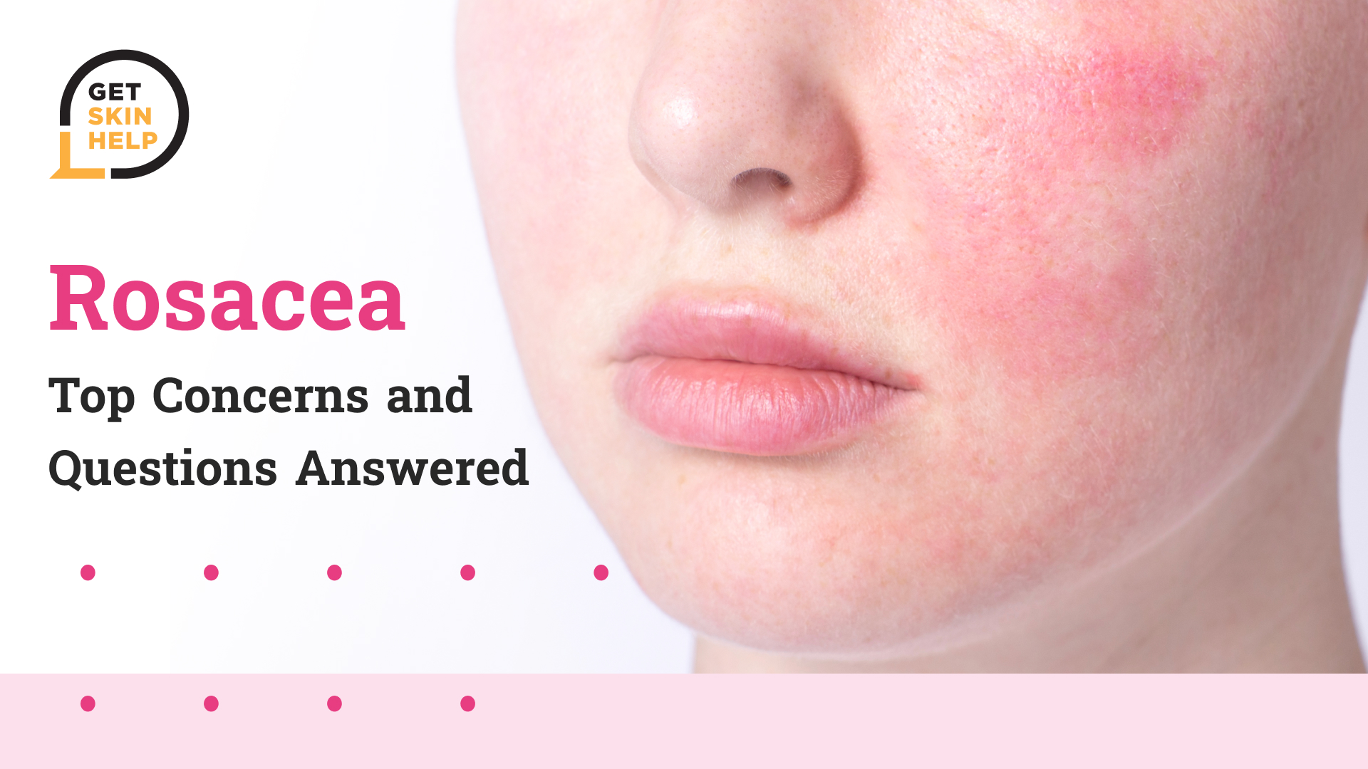 Rosacea
