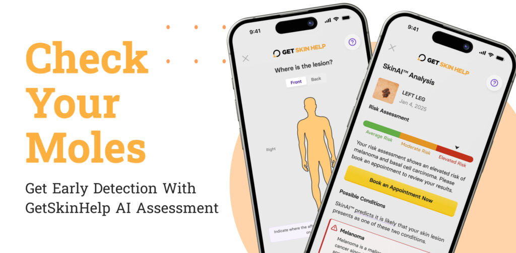 melanoma GetSkinHelp AI assessment img