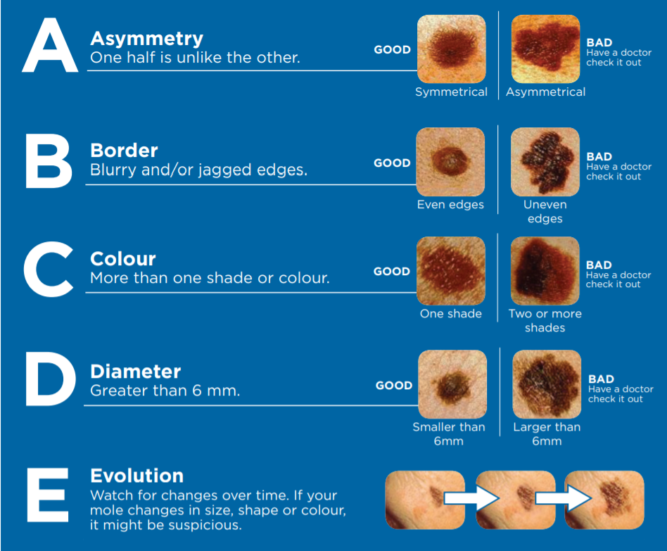 melanoma ABCDE of Melanoma