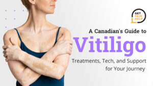 A Canadian's Guide to Vitiligo: Treatments, Tech, and Support for Your Journey