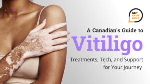 A Canadian's Guide to Vitiligo: Treatments, Tech, and Support for Your Journey
