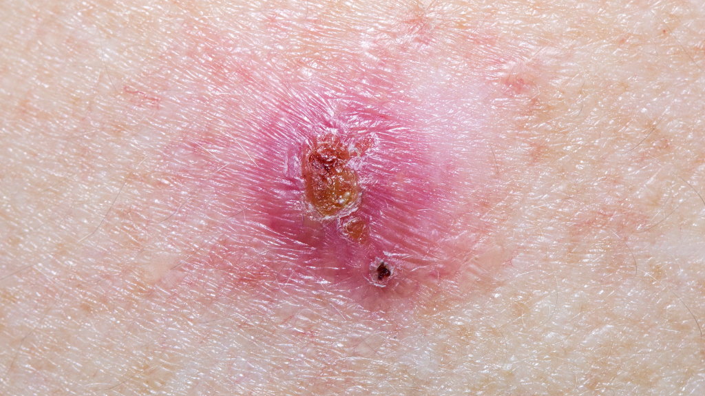 Basal Cell Carcinoma