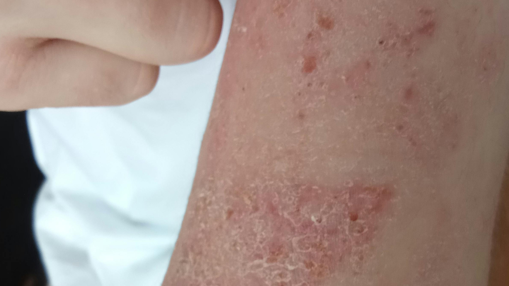 dermatitis on forearm