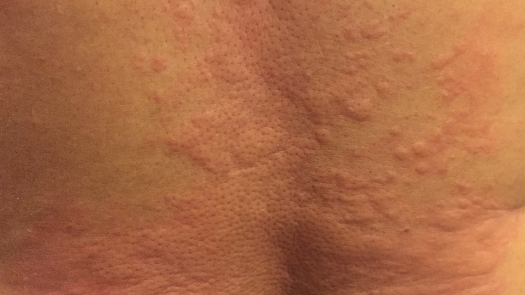 hives on back