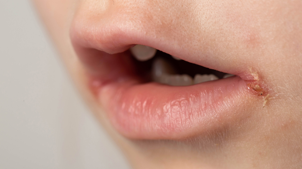 slit-like impetigo in a little girl in the corners of her mouth