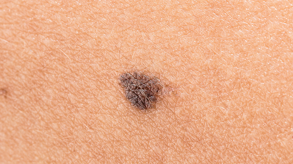macro close up view of Melanoma on caucasian skin