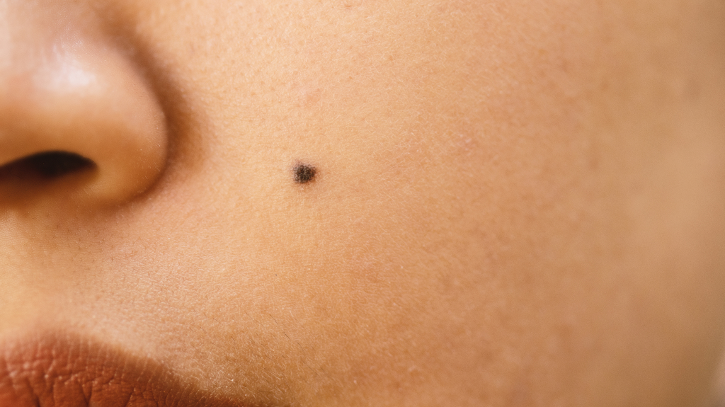 mole on woman's face