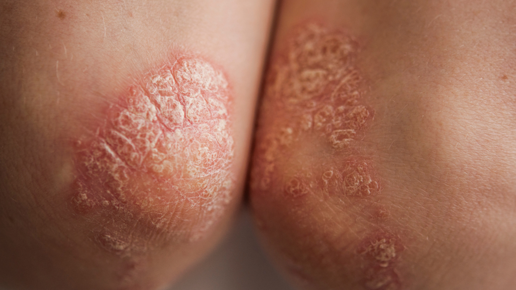 psoriasis