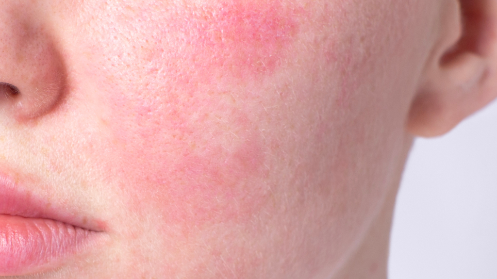 rosacea