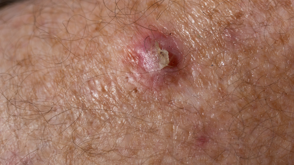 SCC skin cancer on senior males' leg