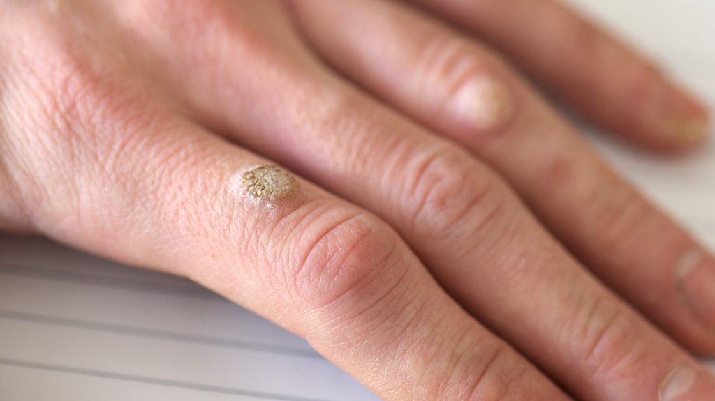 wart on hand