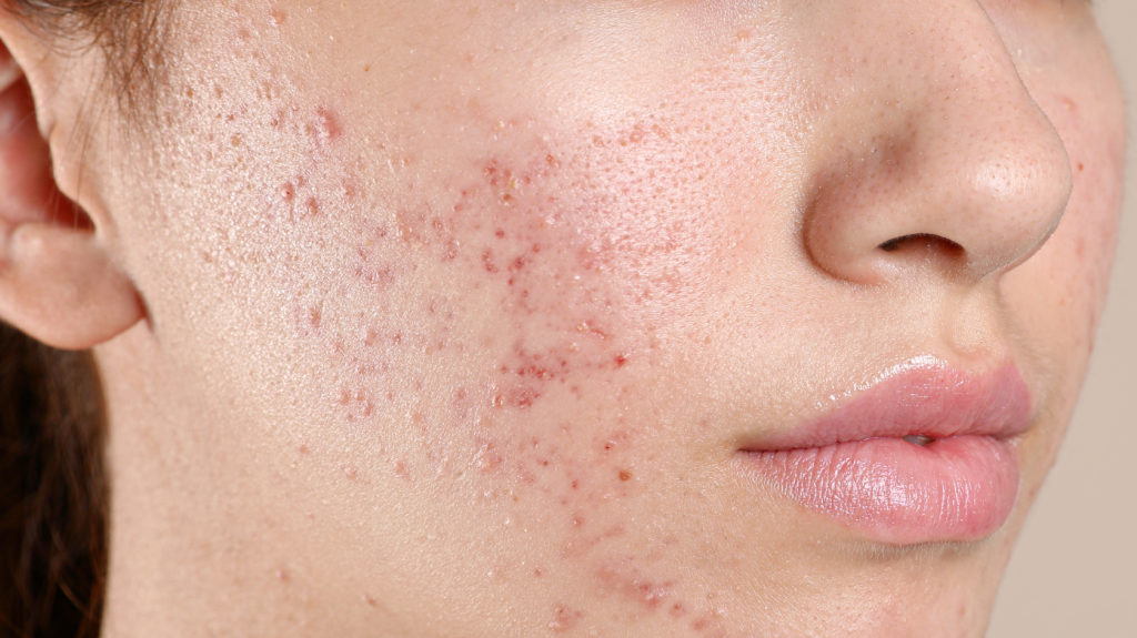 Young female with acne